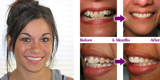 teeth braces for adults. dental braces treatment.